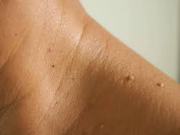 Cut off a small, hanging tag with sharp, clean scissors. Skin Tags Identification And Removal