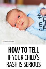 How To Tell If Your Child S Rash Is Serious A Great Guide To Childhood Rashes By A Pediatric Doctor This Baby Has A Rash T Breastfed Baby Baby Rash Baby Care
