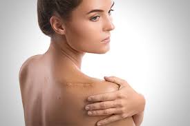 A lingering sign of damage. Contractubex Treating Scars Successfully