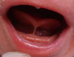 Frenillo Lingual Corto O Anquiloglosia Alba Lactancia Materna