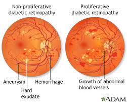 If left untreated, hyperglycaemia can lead to diabetic ketoacidosis (dka), which can eventually cause unconsciousness and even death. Diabetes Type 2 Lima Memorial Health System
