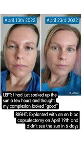 Can anyone help me to understand me? I had breast augmentation, tummy tuck  with lipo