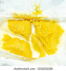 Image result for yellow stool human poop