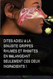 Dites Adieu A La Sinusite Grippes Rhumes Et Rhinites En Melangeant Seulement Ces Deux Ingredients Rhume Grippe Sinusite Ing Medical Vicks Vaporub Qigong