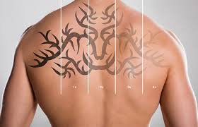 More images for laser tattoo removal results pictures » On Demand Laser Tattoo Removal Atlanta Ga