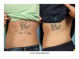 El Dorado Laser Tattoo Removal Before And After Gallery