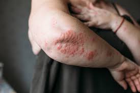Image result for Neurodermatitis