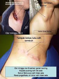 Kanker getah bening, atau biasa disebut limfoma, adalah kanker yang muncul pertama kali pada kelenjar getah bening. Jual Obat Kanker Getah Bening Kota Tasikmalaya Toko Windha Herbal Tokopedia
