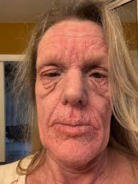 How to clear face breakouts caused by steroids?