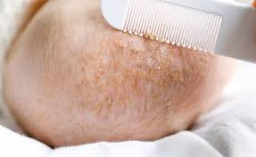 Image result for Cradle Cap