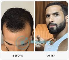 If you have sparse facial hair, patchiness or any facial scars, a beard transplant, also known as a facial hair transplant, may be the solution for you. Best Hair Transplant Turkey Istanbul Best Hair Transplant Hair Implantation Turkey