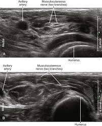 Image result for Axillary Nerve Block