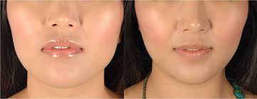 In The Spa Bond En Avant Facial Contouring Botox Plastic Surgeon