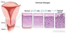 Image result for icd 10 code for high risk hpv infection