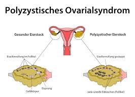 Ech hunn erausfonnt datt ech pcos no mengem mann hat an ech probéiert hunn iwwer e joer laang ouni erfolleg ze conceptive. Was Ist Ein Polyzystisches Ovarialsyndrom