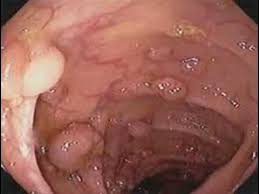 Bowel cancer refers to a cancerous growth in either the large bowel, also known as the colon, or the rectum, which is at the very end of the bowel. 5 Major Colon Cancer Symptoms In Men And Women Youtube