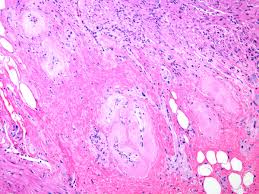 Image result for Radiation Colitis