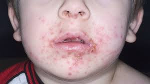 Oral cancer may as well be to blame for those white bumps on the lips. 10 Impetigo Faqs And The Answers Everyday Health