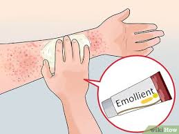 Image result for Contact Dermatitis
