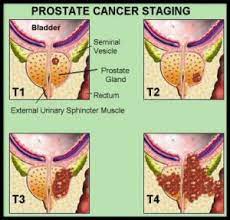 Getting a diagnosis of bladder cancer can be a difficult time. Urological Cancer Chin Chong Min Urology Robotic Surgery Centre
