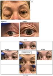 Image result for Pupillary Paralysis