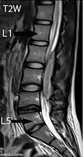 Maybe you would like to learn more about one of these? Lumbar Spontaneous Pyogenic Epidural Spinal Abscess With Cauda Equina Syndrome A Rare Case Sciencedirect