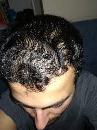 Sac Dokulmem Hakkinda Yardim Edin