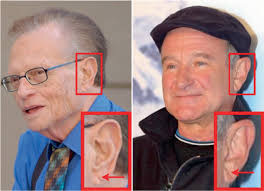 Exploring Data Augmentation Strategies for Diagonal Earlobe Crease  Detection