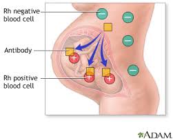 Image result for Rh Sensitization