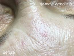 Image result for Sebaceous Hyperplasia