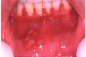 Two herpes subtypes may cause these sores. Herpes Simplex Virus Hsv Infection Of The Mouth European Association Of Oral Medicine