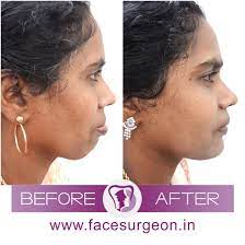 5 Things You Must Know About Jaw Surgery In India
