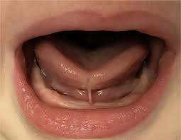 Image result for Ankyloglossia