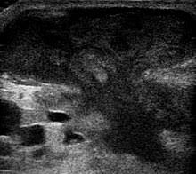 Jump to navigation jump to search. Abscess Wikipedia