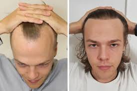A receding hairline can start creeping backwards any time after the end of puberty, and will usually become noticeable by the time most men reach their late 30s. Hair Transplant Results 2019 Mature Or Receding Hairline Thinning Hair Baldness Repair