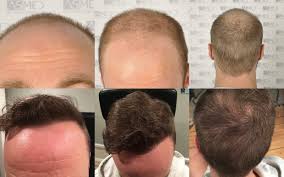 Lindsey he's a 31 year old guy who has fine hairs, very white skin, and is now 19 months out from starting with us. Norwood 6 Hair Transplantation Results Asmed Hair Transplant