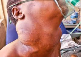 Image result for Multinodular Goiter