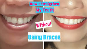 Luckily, there are other ways to straighten your teeth without getting braces fitted; How I Straighten My Teeth Without Using Braces My Mewing Progress Update Youtube