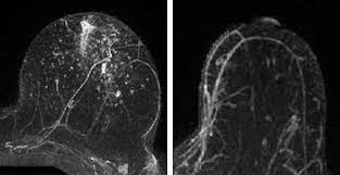 On a breast mri, the contrast tends to become more concentrated in areas of cancer growth, showing up as white areas on an otherwise dark background. True Risk Of Breast Cancer Mri Could More Precisely Pinpoint Chances Of Developing Disease