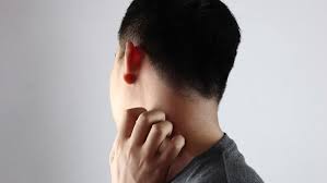 Carbuncle adalah kumpulan bisul yang berkembang dalam kelompok folikel rambut di bawah kulit. Jenis Penyakit Kulit Dibedakan Dari Yang Menular Dan Tidak Menular