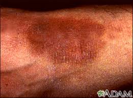 Lichen simplex, sometimes called neurodermatitis, presents as a localised demarcated plaque, usually with scaling, excoriations and lichenification (increased skin markings and thickened skin) on the. Lichen Simplex Chronicus Information Mount Sinai New York