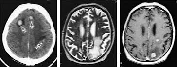 Metastatic breast cancer symptoms depend on the part of the body to which the cancer has spread and its stage. Neurological Complications Of Systemic Cancer American Family Physician