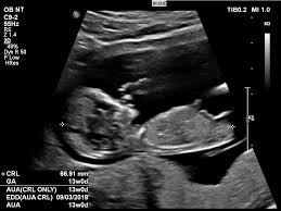 Image result for Ultrasound
