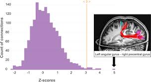 Asds are brain disorders that make it in addition, asperger's syndrome can cause some problems with motor skills, such as coordination. A Case Of Co Occuring Synesthesia Autism Prodigious Talent And Strong Structural Brain Connectivity Bmc Psychiatry Full Text