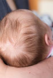 Image result for Cradle Cap