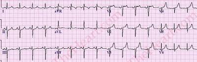 Left Anterior Fascicular Block Lafb Ecg Review Criteria