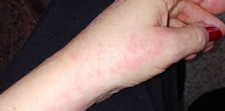 Zona zoster este o infecție virală ce afectează rădăcinile nervoase și este caracterizată prin durere și apariția unei bande eruptive, ce se întinde pe o singură parte a corpului. Zona Zoster Cauze Simptome Tratament