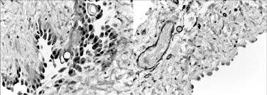We did not find results for: Benign Multicystic Peritoneal Mesothelioma Immunohistochemistry A Download Scientific Diagram