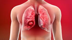 Image result for Lung Cancer