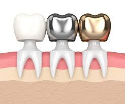 Disadvantages of porcelain crowns in Vietnam
